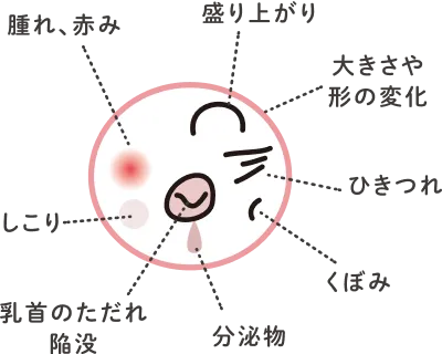 乳房の症状を示したイラスト