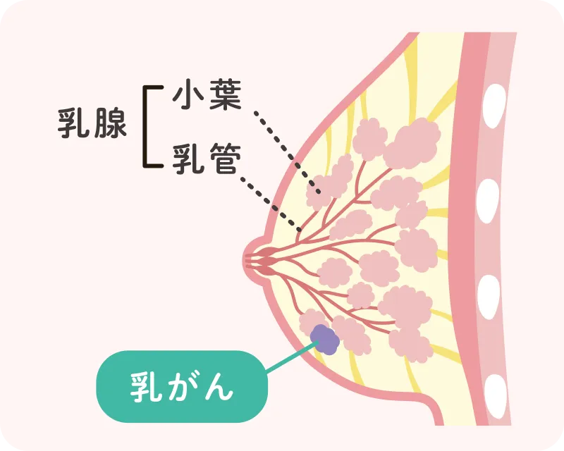 乳房の構造と乳がんの発生箇所を示した医学的イラスト。