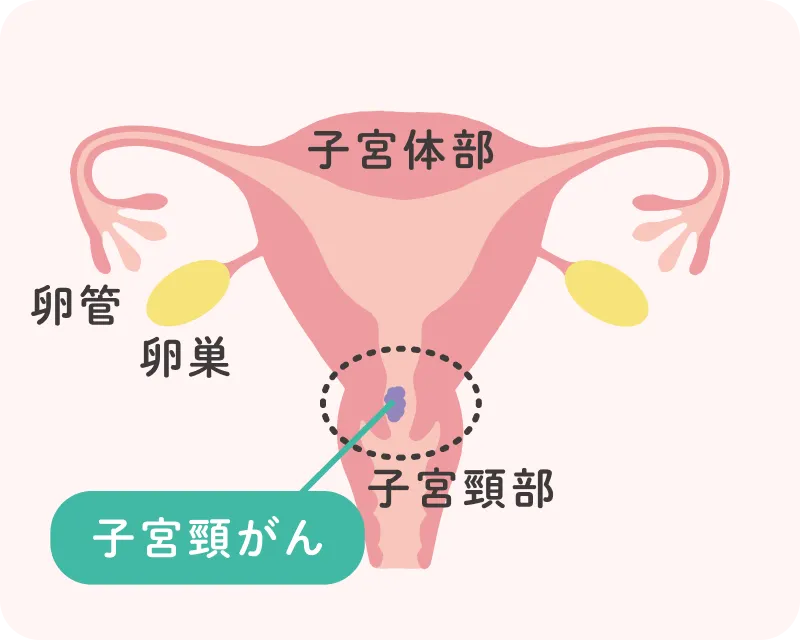 子宮体がんと子宮頸がんの発生部位を示した子宮のイラスト。